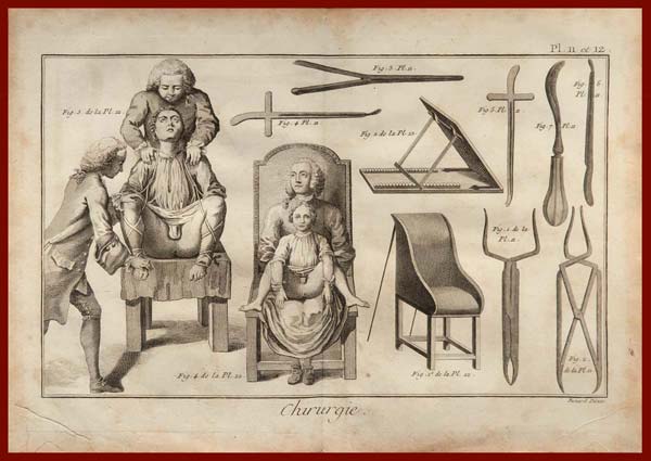 stampa antica chirurgia diderot